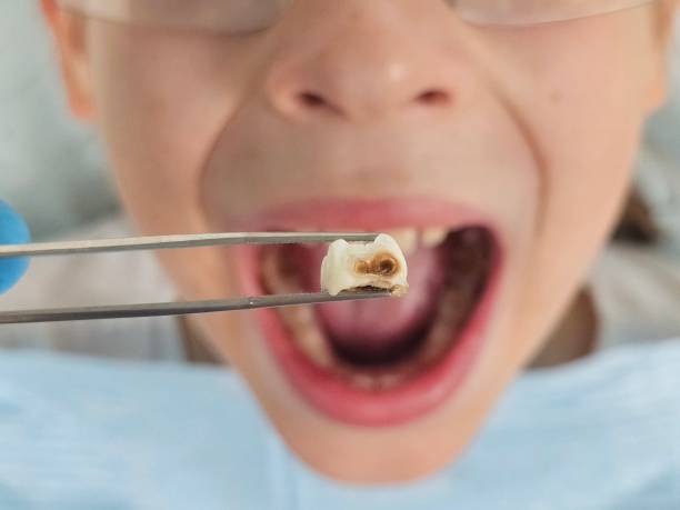 Best Emergency Root Canal Treatment in Carrizo Hill, TX